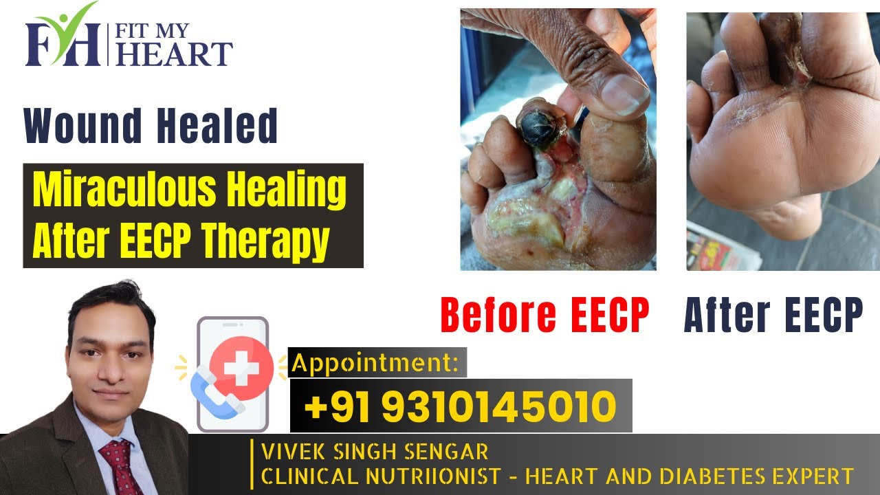 Miraculous Healing After EECP Therapy: Wound Healed | Dr. Rakesh Mohanlall