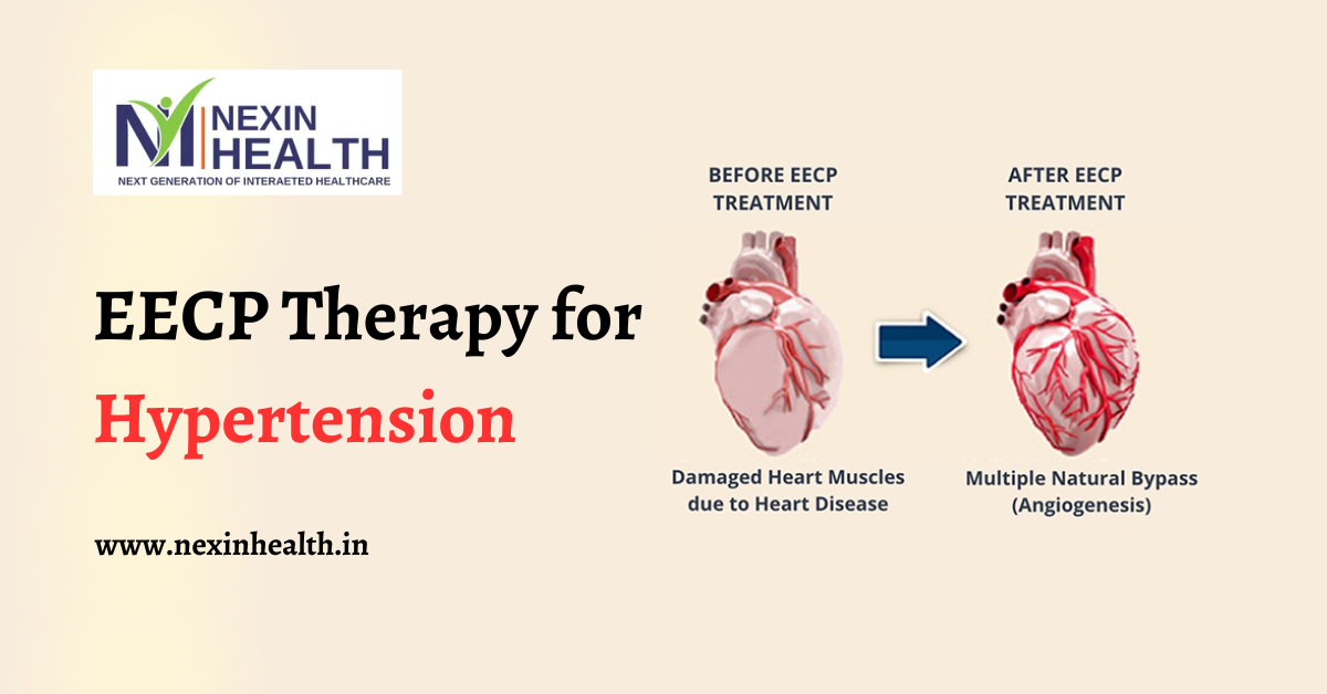 EECP Therapy for Hypertension: Can It Help Lower Blood Pressure?