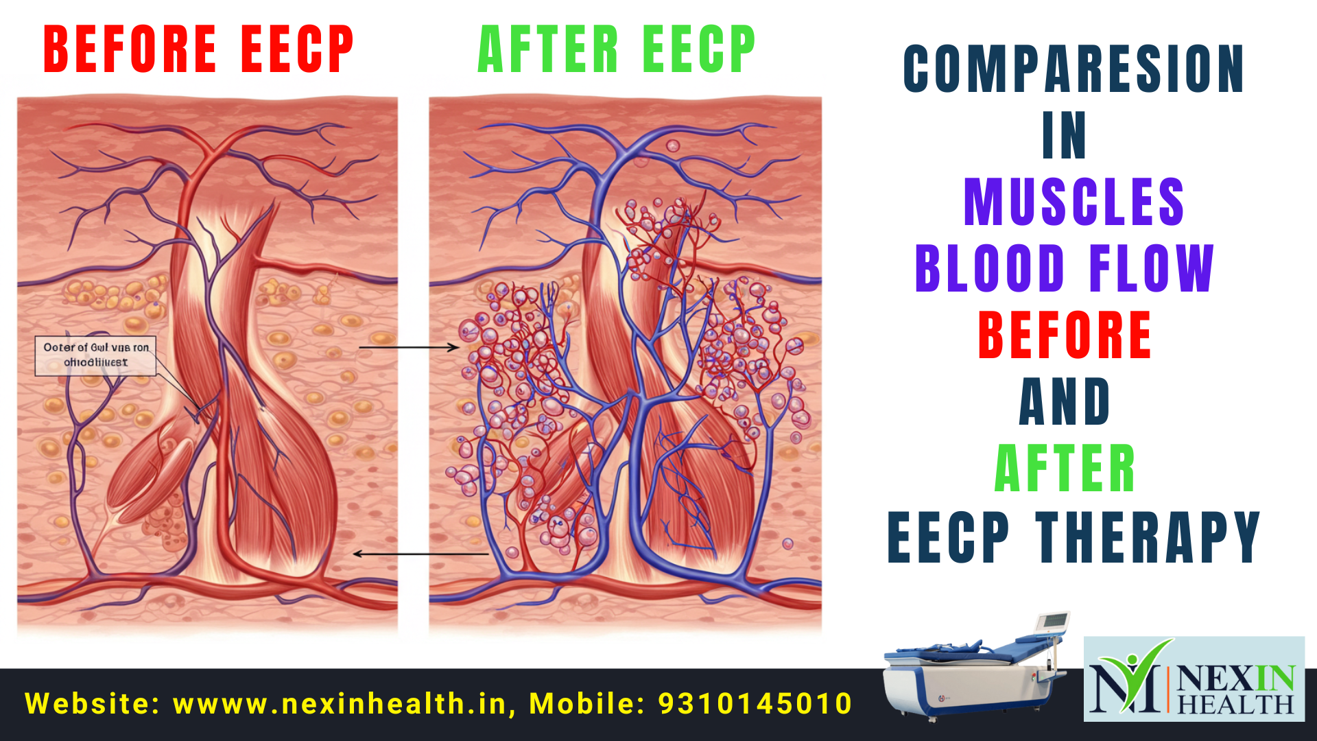 What is Natural Bypass: EECP Therapy – Best Treatment for Heart Health