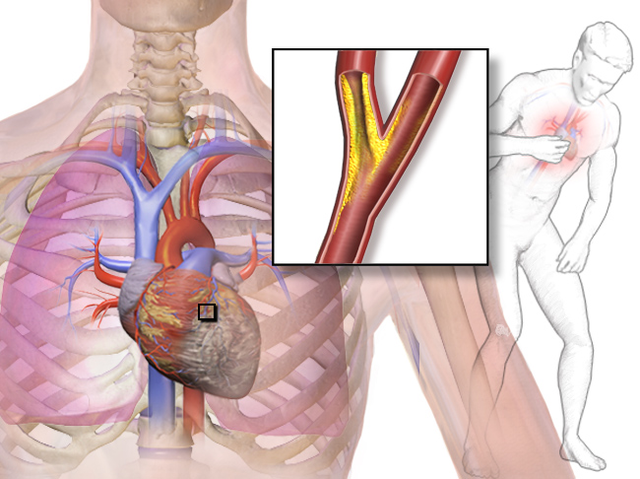 chronic angina 