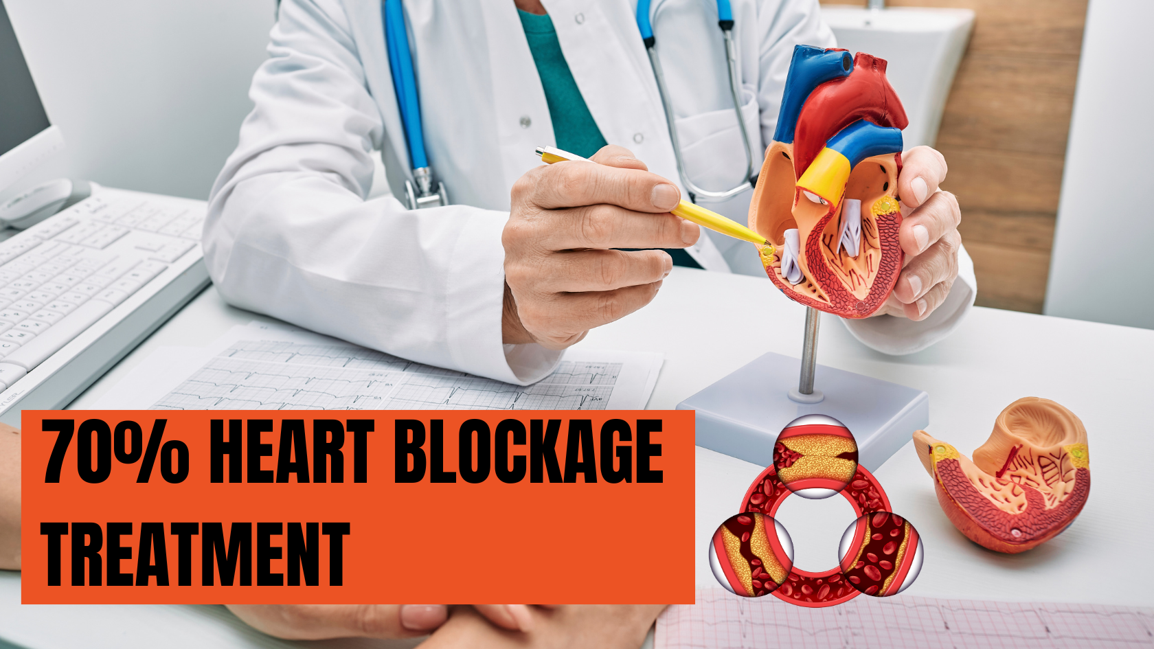 70 Percent Heart Blockage Treatment: What is the Best Option